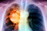 Tumore polmonare, la rivoluzione dell’immunoterapia spiegata dal Dottor Rocco – AIPO